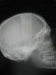X-ray of human skull. I know who it is, a very poisonous lady, but it remains a secret. Dim. ...